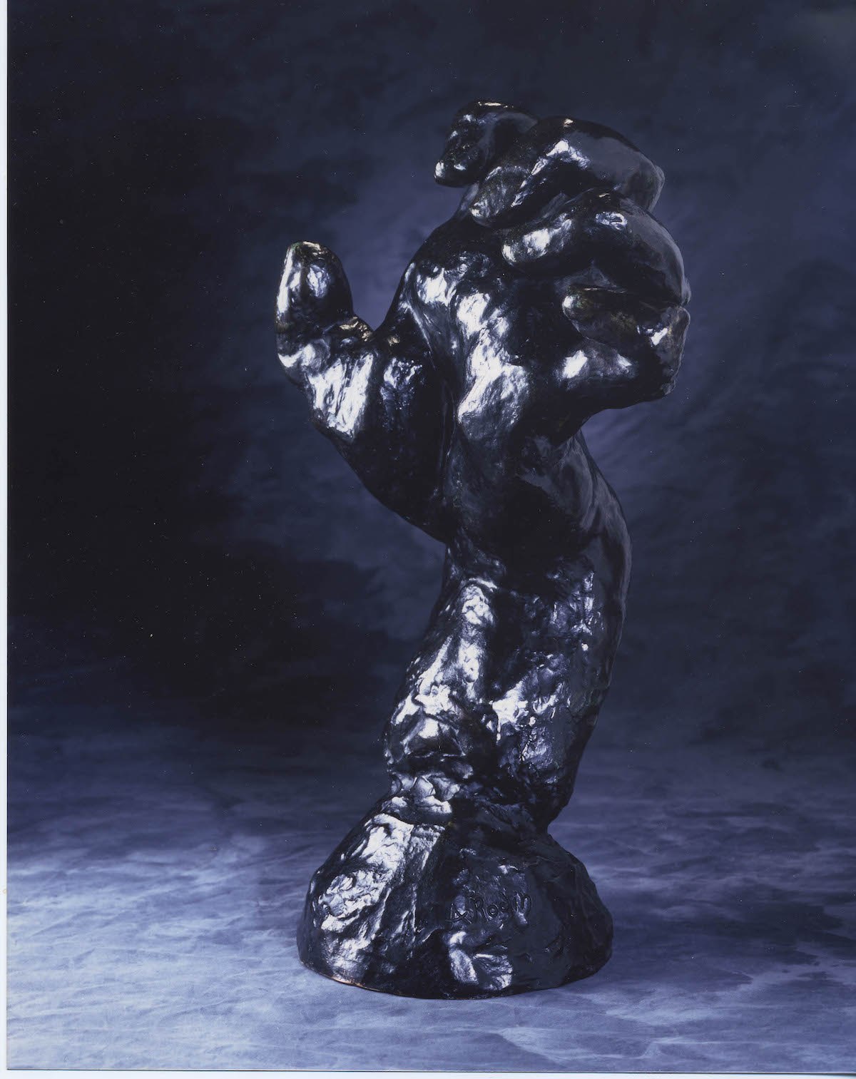 The Real Medical Conditions Behind the Deformed Hands in Rodin's